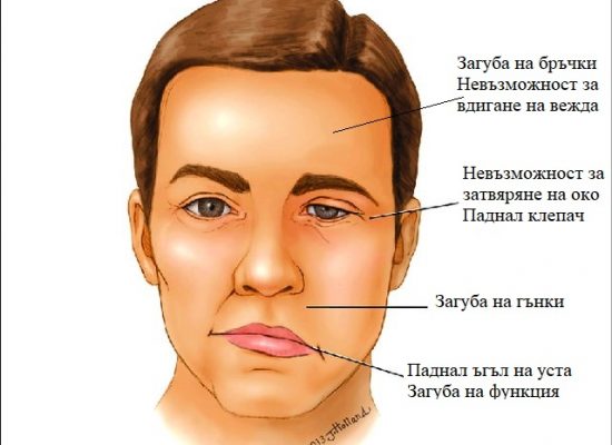 Парализа на Бел