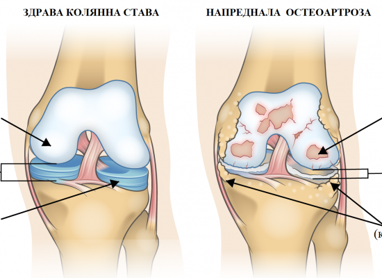 Остеоартроза